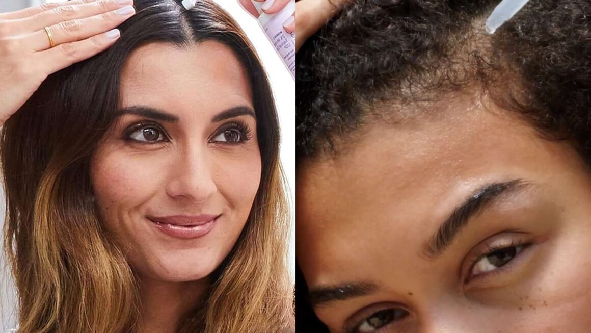Hair Loss